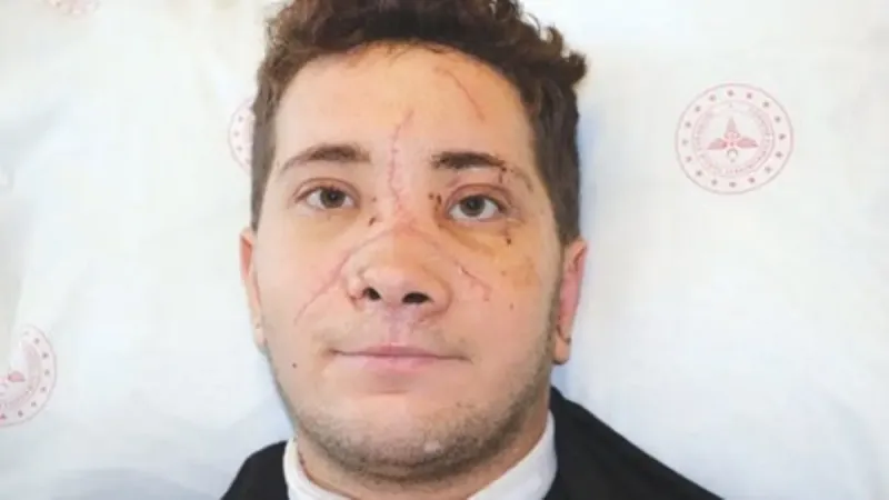 Burun Mucizesi! Kamyonet Vurdu, Doktorlar Yeniden Yarattı
